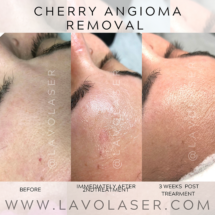 IPL Skin Rejuvenation Lavo Laser Skin Care Clinic Sydney